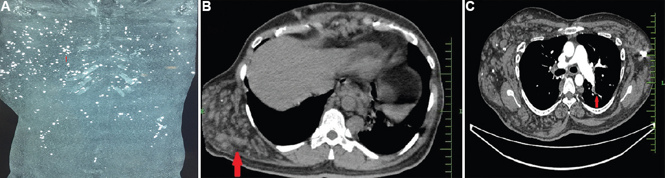 (A) CT chest with pulmonary angiogram showed extensive phleboliths in the chest and abdomen (arrow). (B) Haemangiomata over the right posterolateral chest wall (arrow) in CTPA. (C) Thrombus in the left lobar pulmonary artery (arrow).